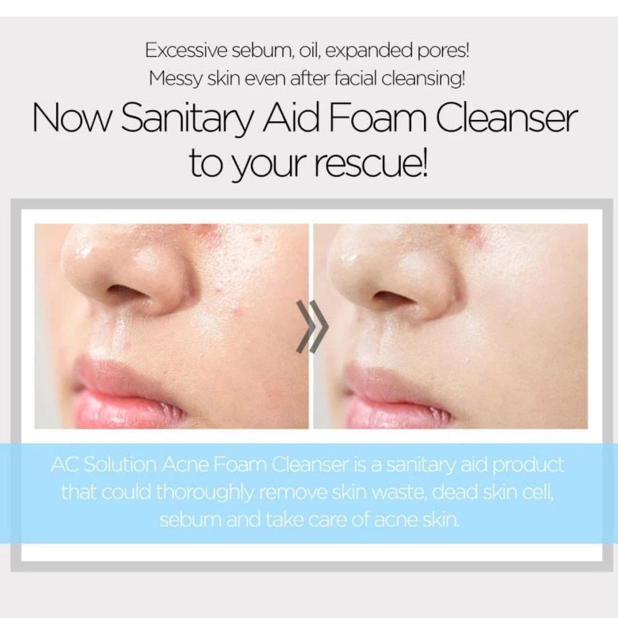 AC Solution ACNE Foam Cleanser | Gel limpiador de acné - Koelleza Store